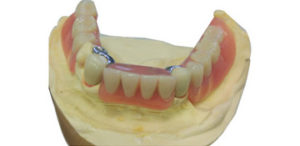 Metal Framework for Removable Dentures